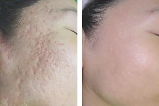 Top 9 kem trị sẹo lõm hiệu quả bất chấp tuổi sẹo mà không cần xâm lấn- Ảnh 4.