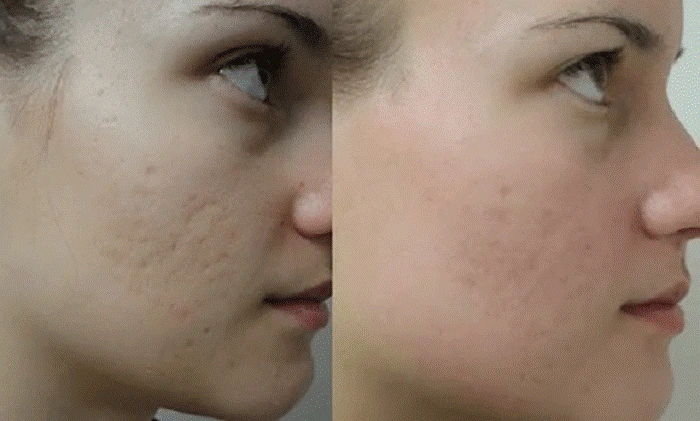 Top 9 kem trị sẹo lõm hiệu quả bất chấp tuổi sẹo mà không cần xâm lấn- Ảnh 6.