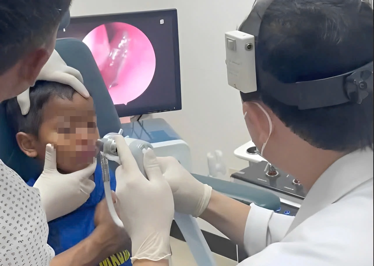 Gắp con đỉa sống ký sinh trong mũi bệnh nhi- Ảnh 1.