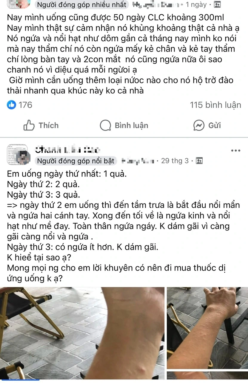 Cẩn trọng trào lưu trên mạng xã hội: Ngứa sau thời gian uống nước chanh, do đâu?- Ảnh 1.