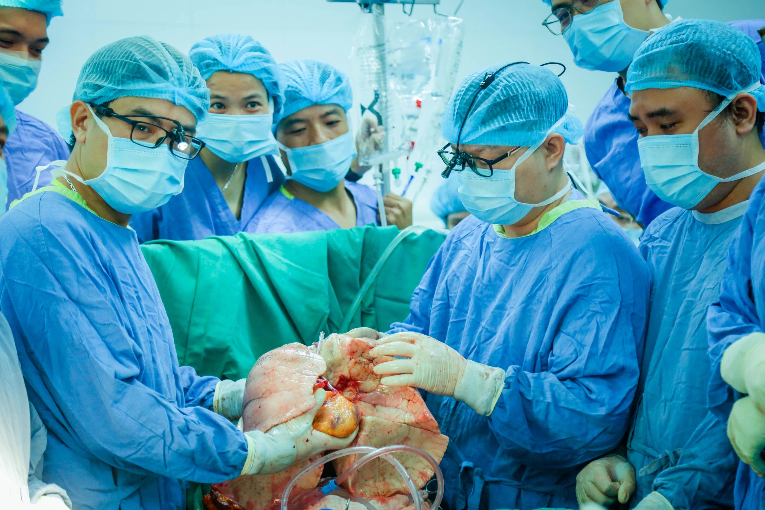 Ca ghép đồng thời tim, phổi đầu tiên thành công tại Việt Nam- Ảnh 1.